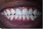 After-DentalImplants-2