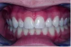 After-DentalImplants