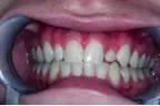 Before-DentalImplants