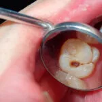 richview-family-dentistry-clarksville-tn-signs-prevention-tips-tooth-decay